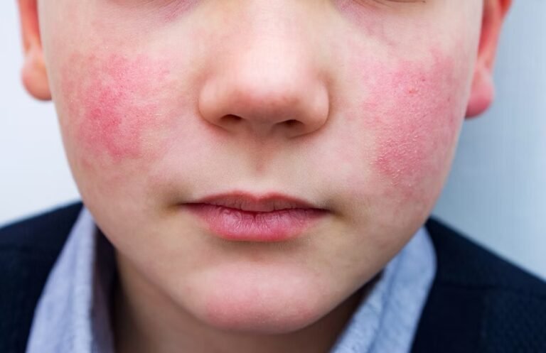 Cinquieme maladie (ou Érythème infectieux)