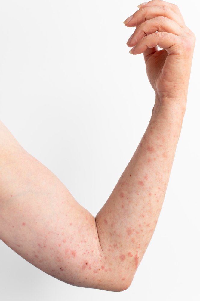 pityriasis versicolor