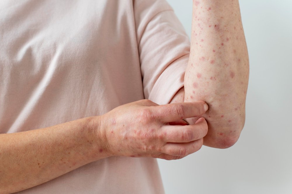 pityriasis versicolor
