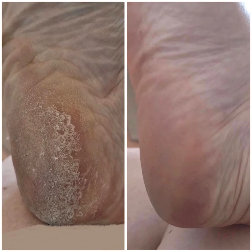 peeling pieds lovaskin