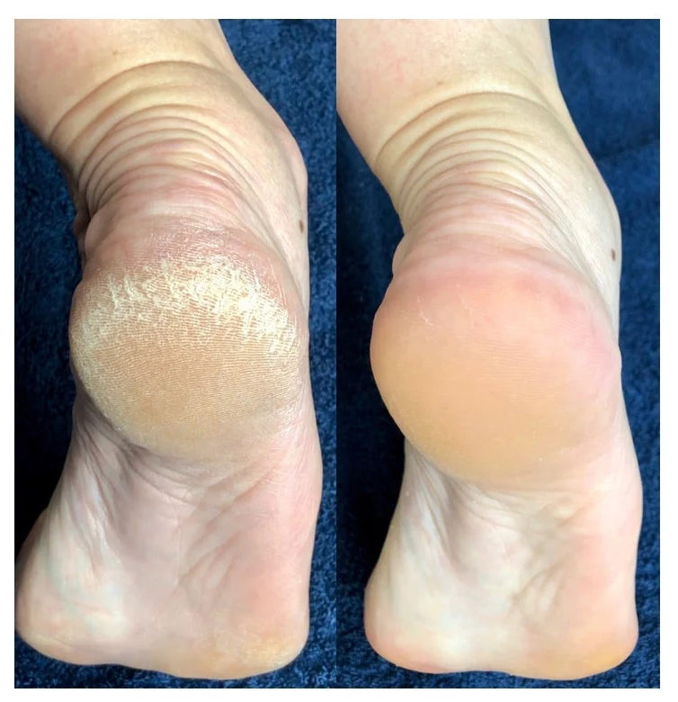peeling pieds lovaskin avant apres